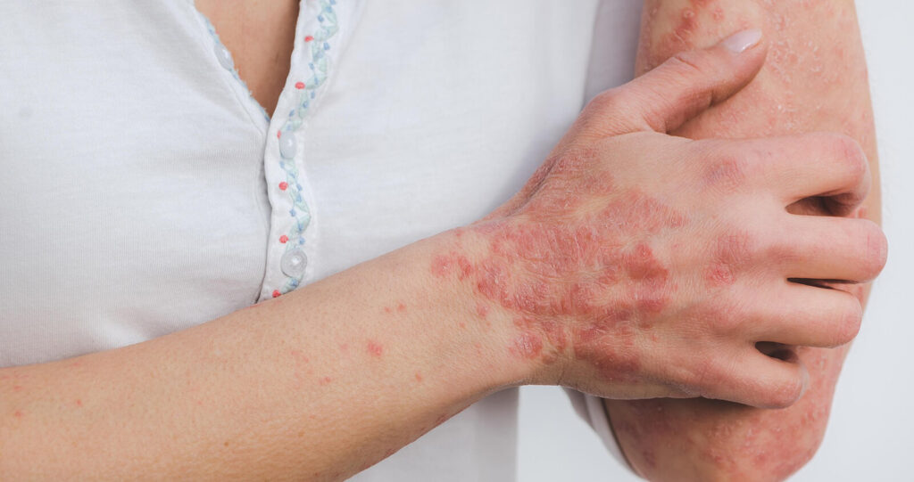 Best Skincare Routine for Eczema Prone Skin Best Skincare Routine for Eczema-Prone Skin